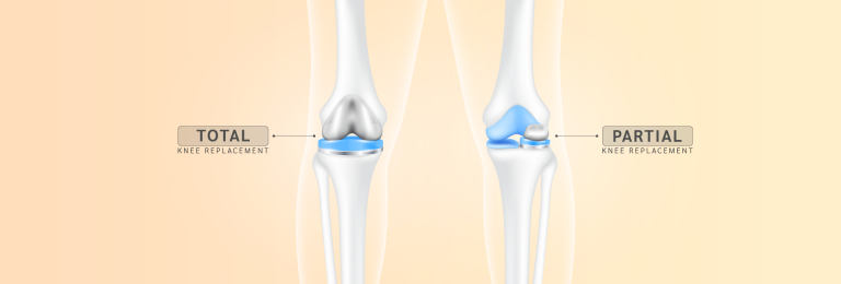 Different knee replacement surgeries: partial, total, and revision