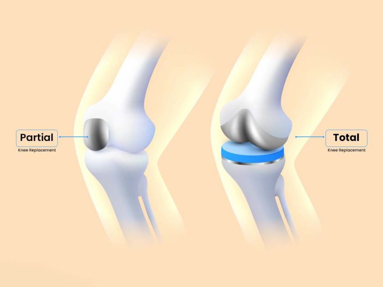 Different knee replacement surgeries: partial, total, and revision