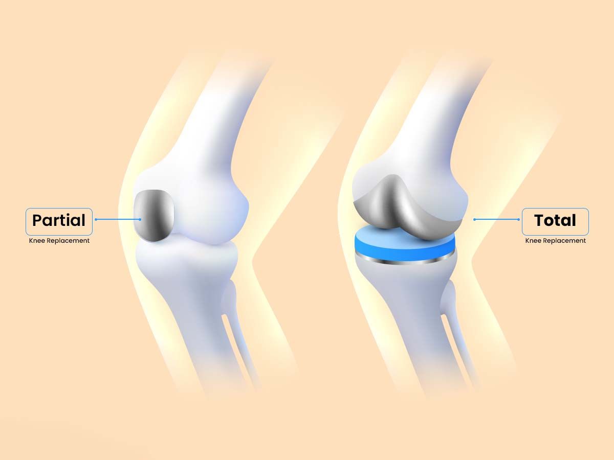 Different knee replacement surgeries partial total and revision