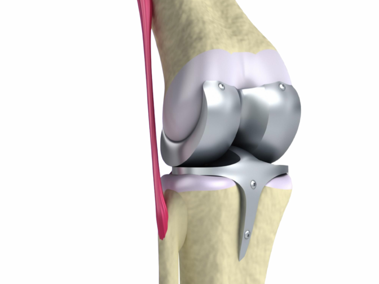 Knee Replacement Surgery: A Simple Overview