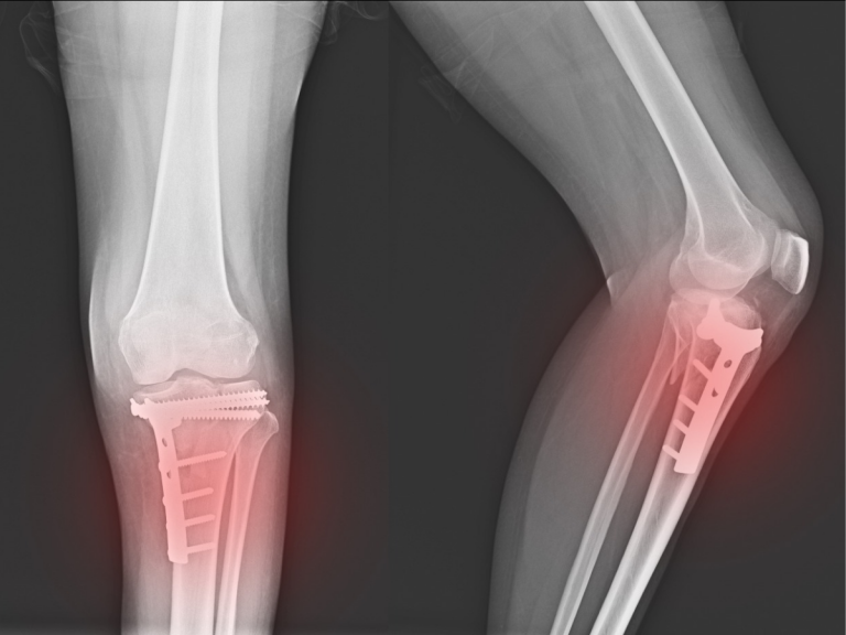 Bone Fractures: Common Symptoms, Treatment Methods, and Potential Risks