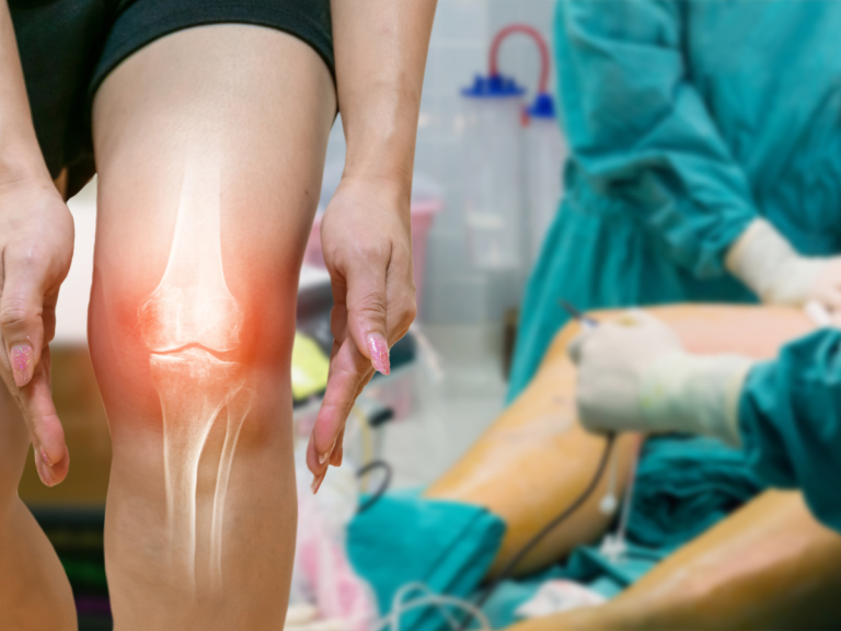  5 Key Symptoms That Signal the Need for Knee Replacement