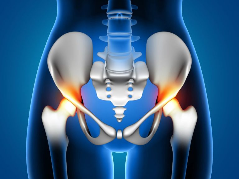 Total Hip Replacement Surgery: Causes, Procedure & Recovery Guide